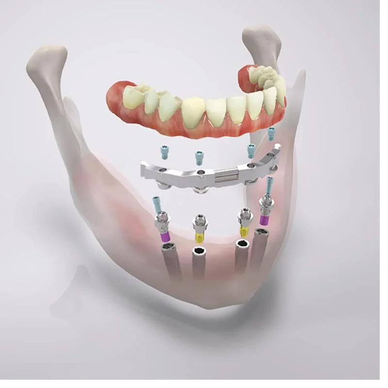 full mouth dental implants Vietnam cost