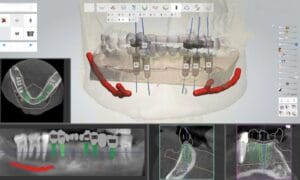 the Best Dental Implant Clinic in Vietnam