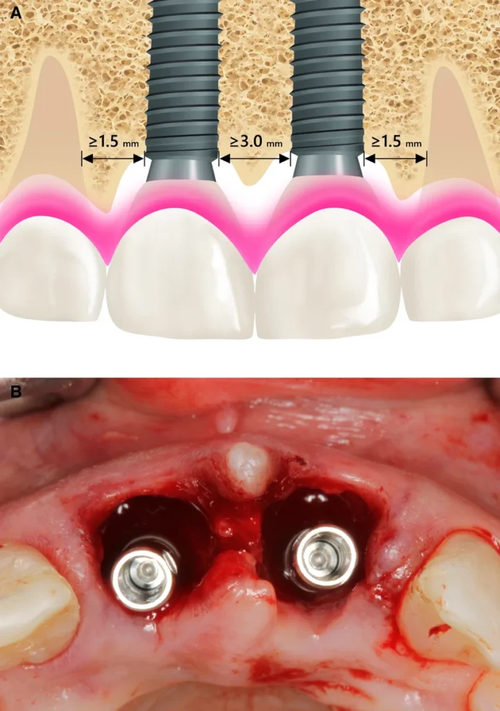 lac viet intech central implant dental Viet Nam