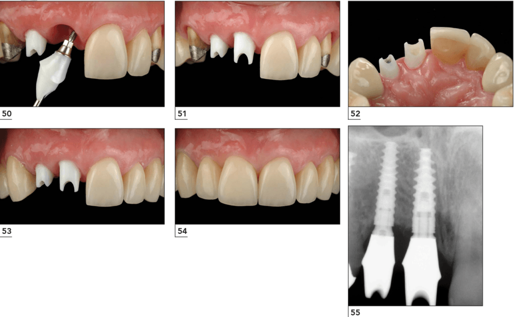 A clinical case utilizing a zirconia customized anatomical abutment.