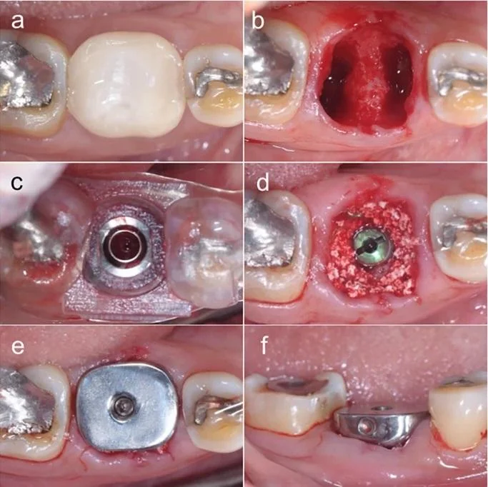 A clinical case of tooth extraction, implant placement via guideline, and placement of a titanium customized healing abutment, all in a single surgical procedure.
