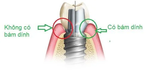 Comparison of biologic width between a prefabricated stock abutment and a customized abutment.