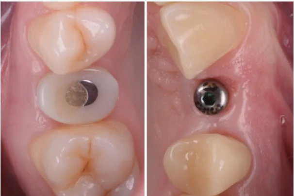 Figure: Comparison of gingival tissue reshaping using customized healing and conventional healing.