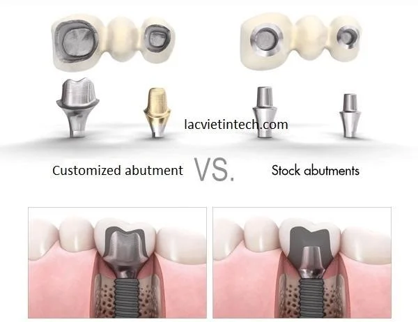 Figure: Comparison of personalized prosthetic posts and stock abutments.