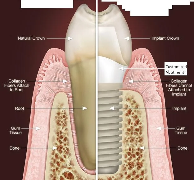 Comparison of the biologic width between a natural tooth and an implant.