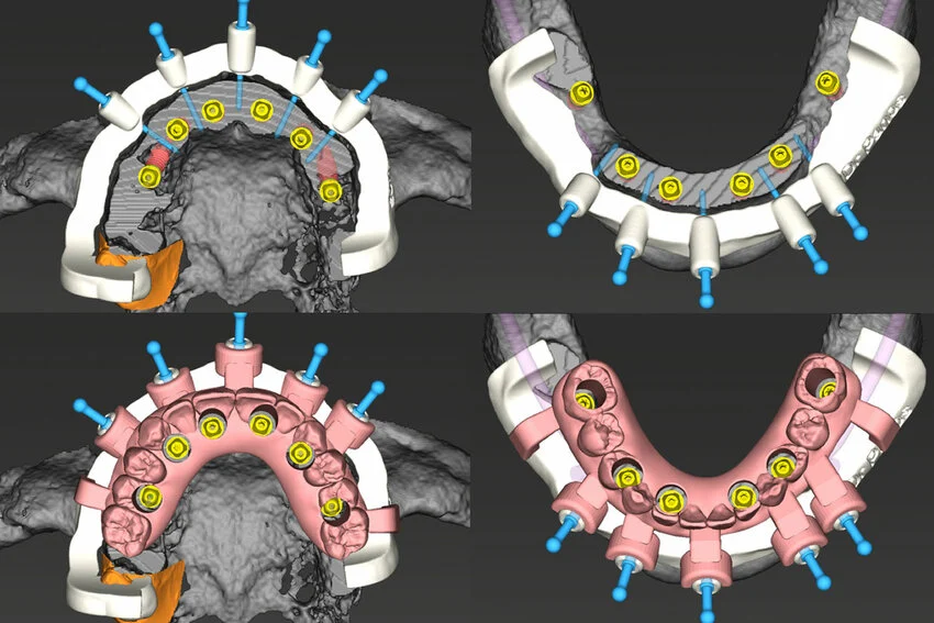 all-on-4-dental-implants-vietnam