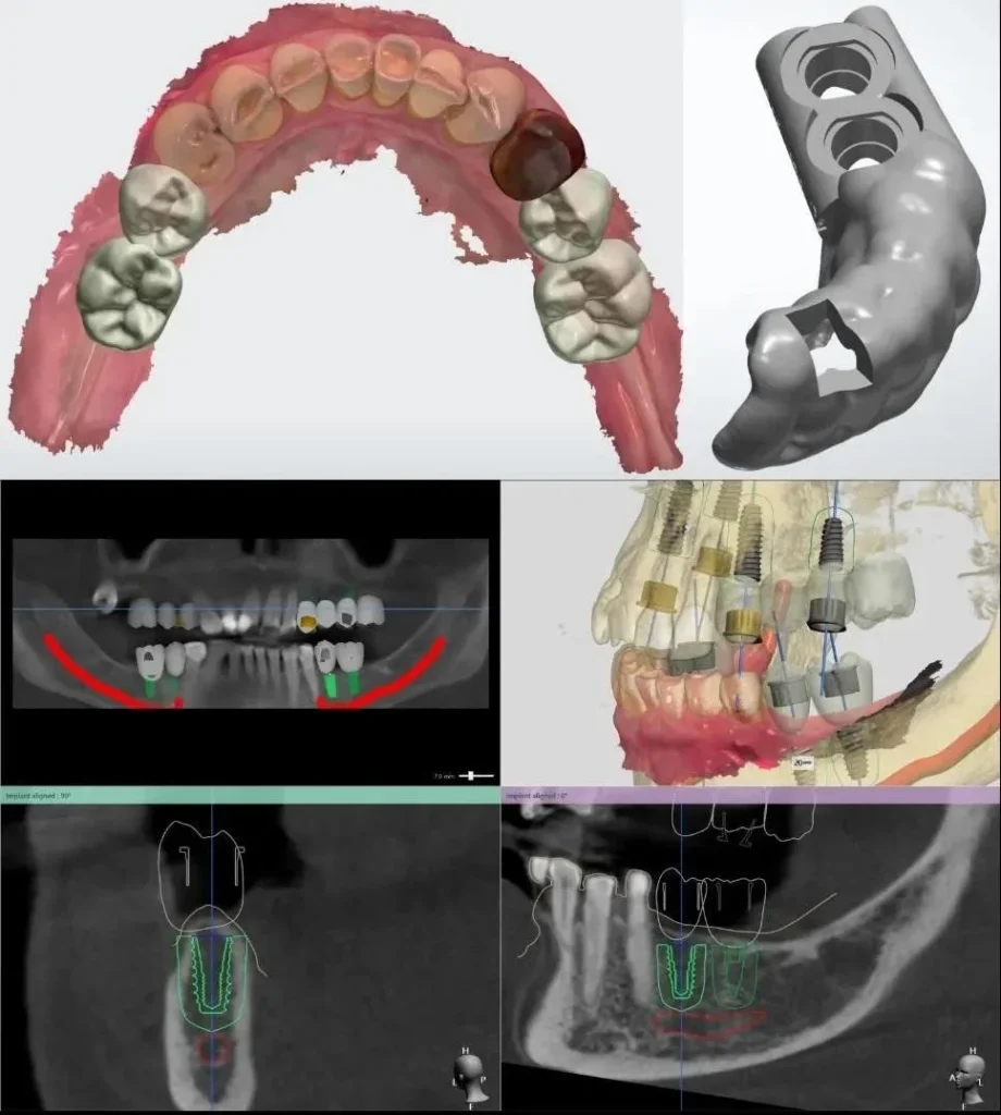 Implant placement planning with Guideline in a clinical case.