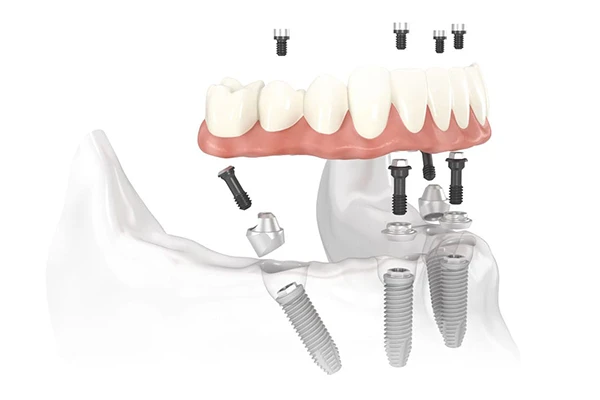 all-on-4-dental-implants-vietnam