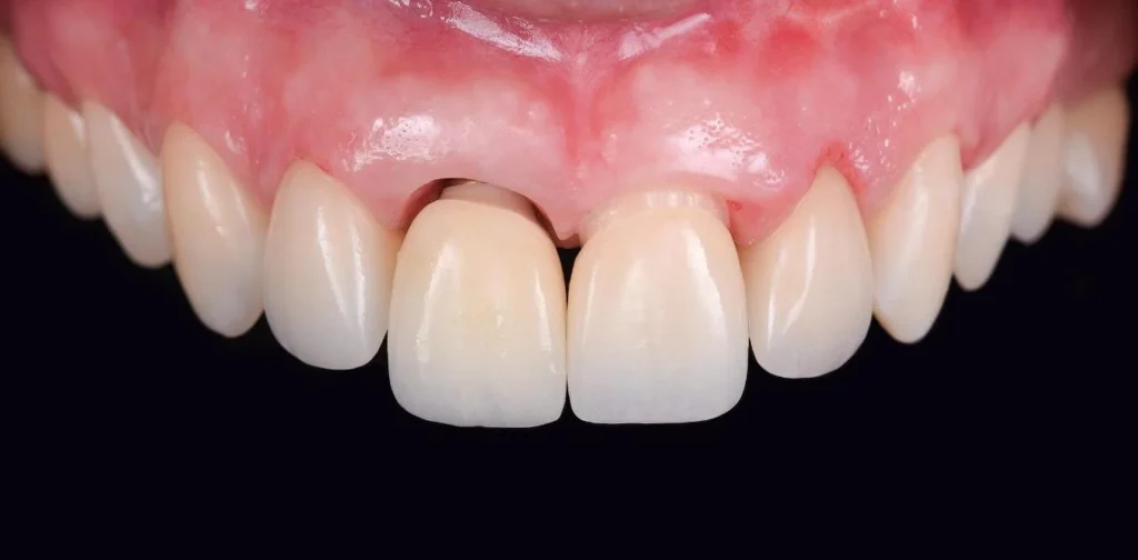 Image of abutment delivery and ceramic crown seating.