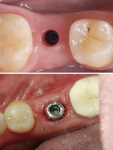 Image of the gingival emergence profile created by a prefabricated healing abutment vs. a prefabricated abutment: small, circular, and non-anatomical.