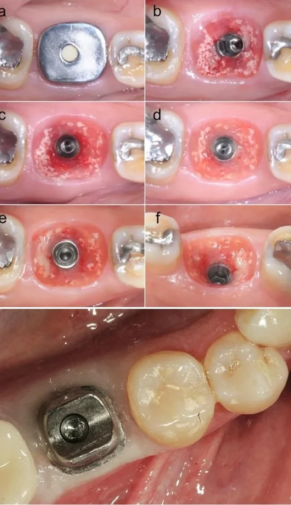 Images showing gingival reconstruction and periodontal contouring according to anatomical standards using a Customized Healing Abutment and shaping with a Customized Abutment.