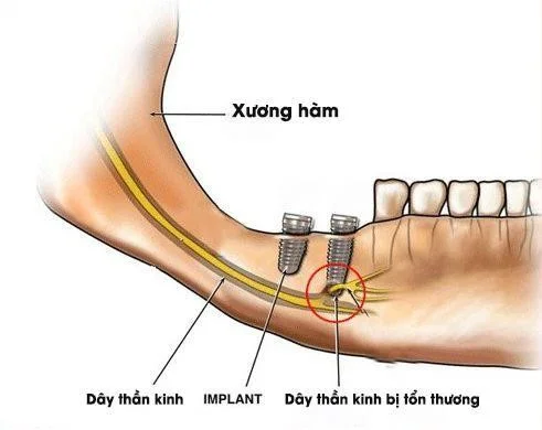 Illustration: Injury to the inferior alveolar nerve caused by inaccurate implant placement.