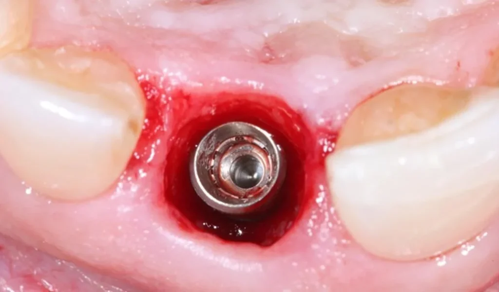The implant fixture is placed accurately via the surgical guide