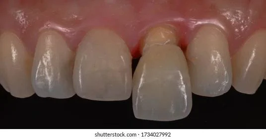 The translucency of the 3D Pro ML ceramic crown mimics that of a natural tooth.