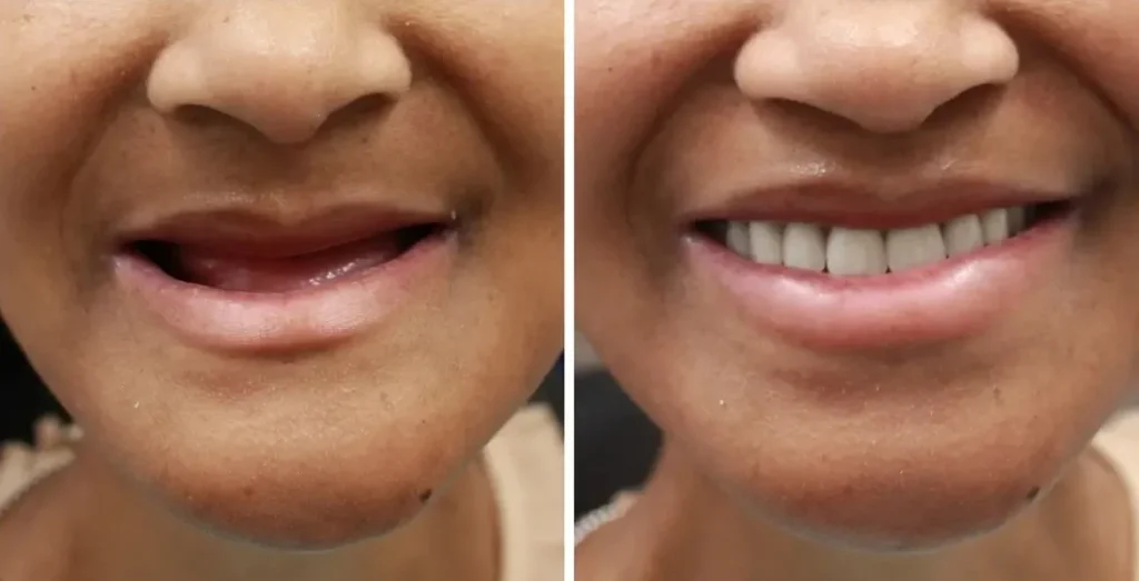 Cheap Dental Implants in Vietnam