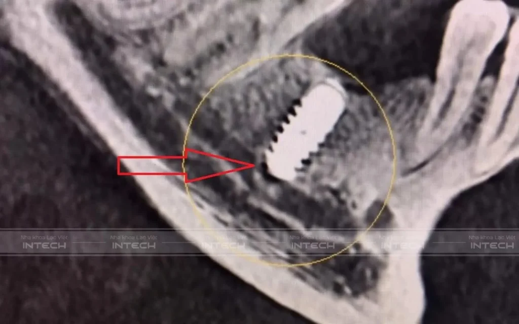 X-ray image showing damage to the inferior alveolar nerve due to incorrect implant placement.