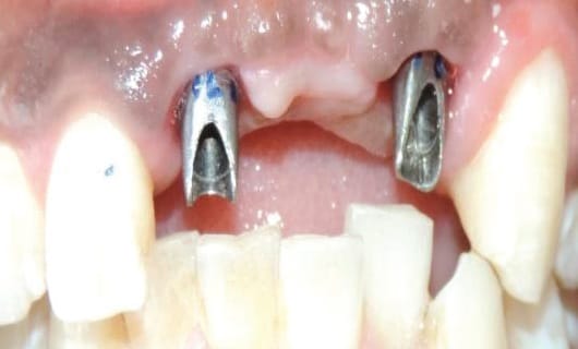 the Best Dental Implant Clinic in Vietnam