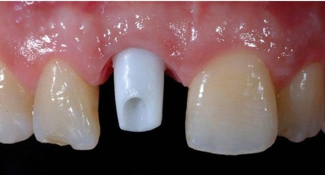 the Best Dental Implant Clinic in Vietnam