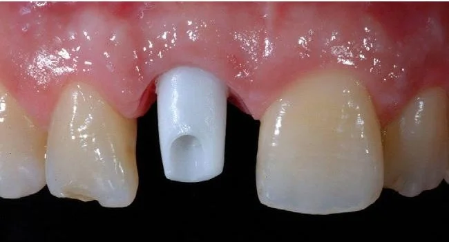 thiết kế 1 ảnh để minh họa cho nội dung bài viết "Cheap Dental Implants in Vietnam: Are They Safe or Risky?"