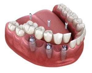 best dental implant clinic Vietnam