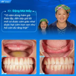 Patient Dang Mui May, undergoing full dental implant surgery for both upper and lower jaws.