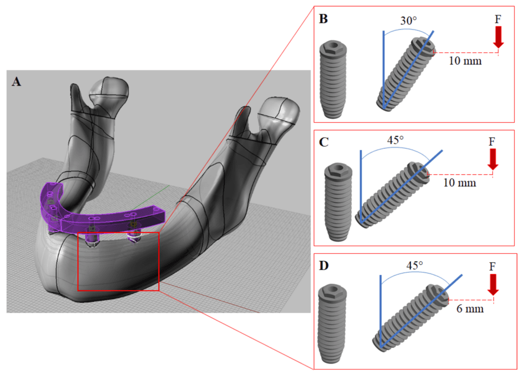 all on 4 dental implants vietnam