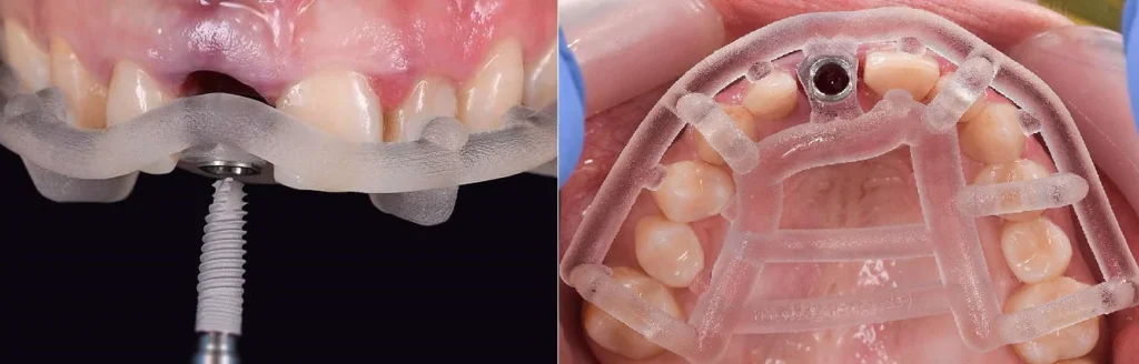 Surgical Guides in Implant Dentistry