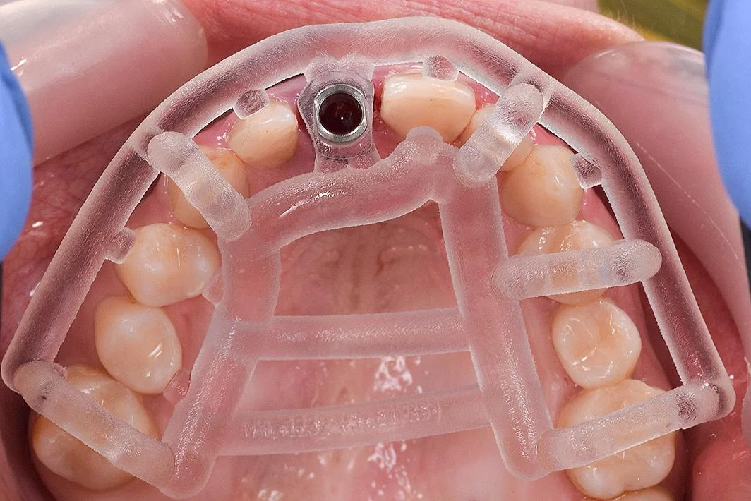 Surgical guide for implant placement.