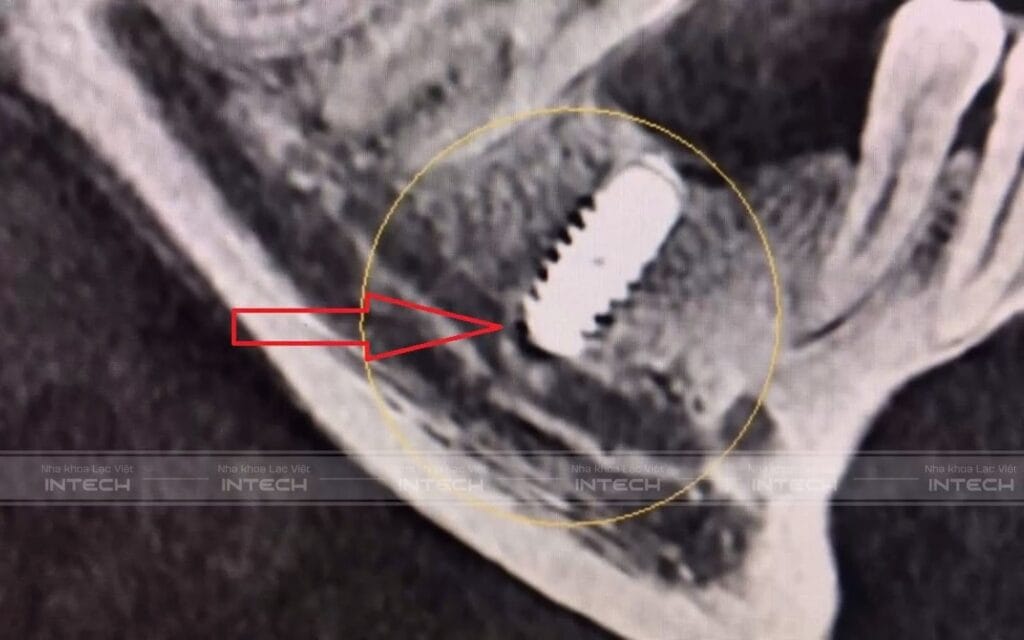 dental implant risks