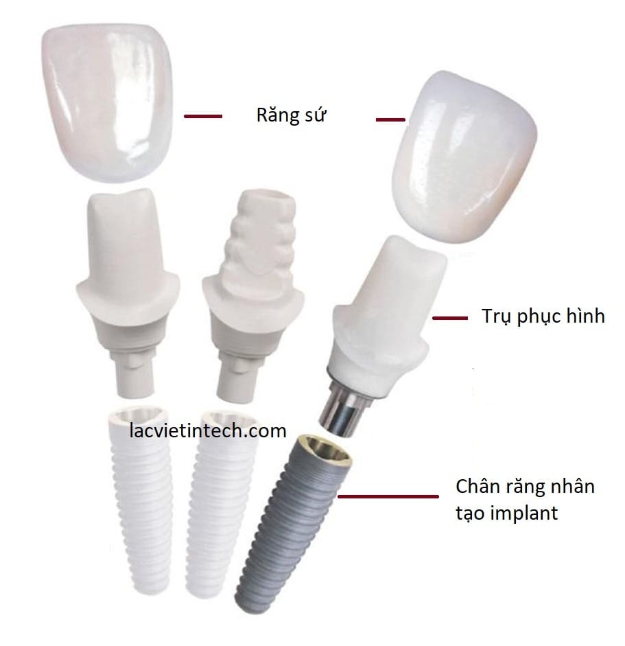 Dental Implant Vietnam