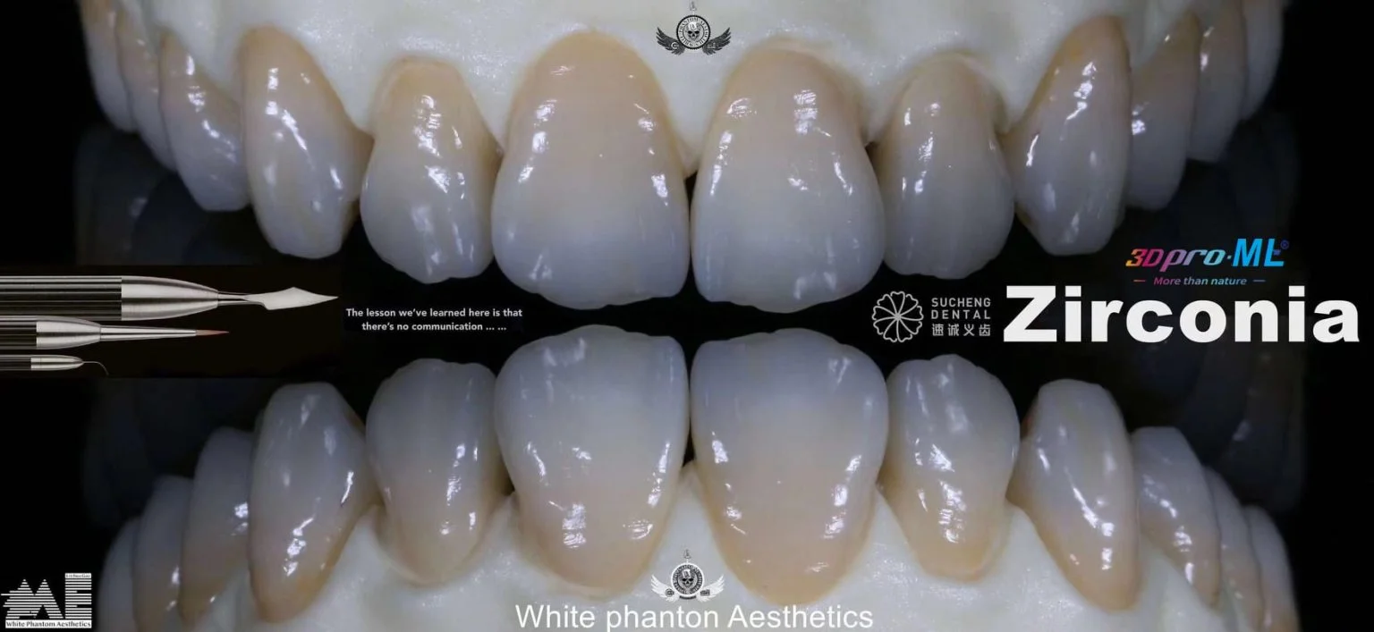 3D Pro Multilayer ceramic crowns overview