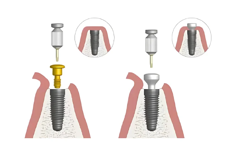 Healing abutment placed after implant surgery