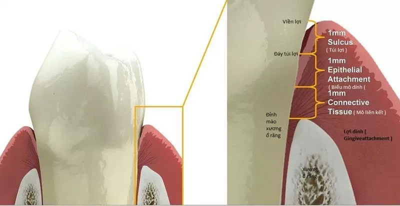 Biologic width around a dental implant