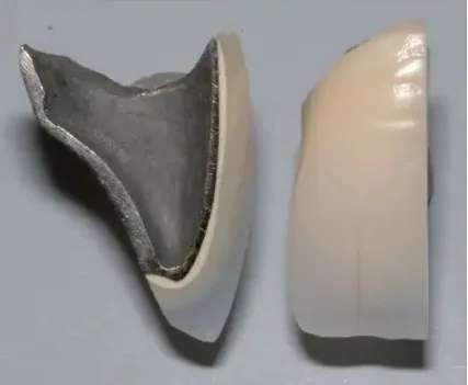 Titanium porcelain crown structure