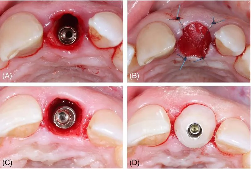 Customized healing abutment shaping gingival anatomy