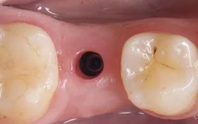 Stock healing abutment emergence profile