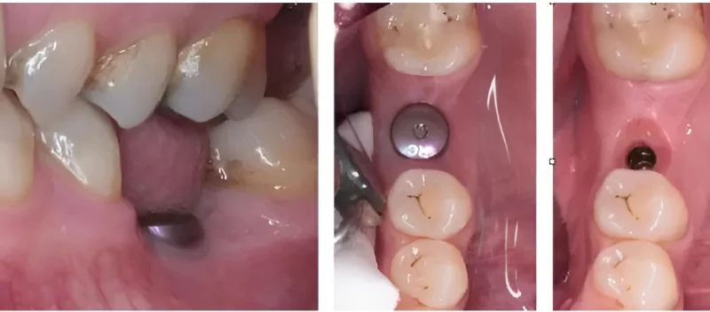 Stock healing abutment made of titanium