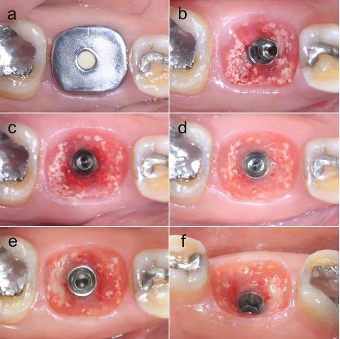 Customized titanium healing abutment after placement