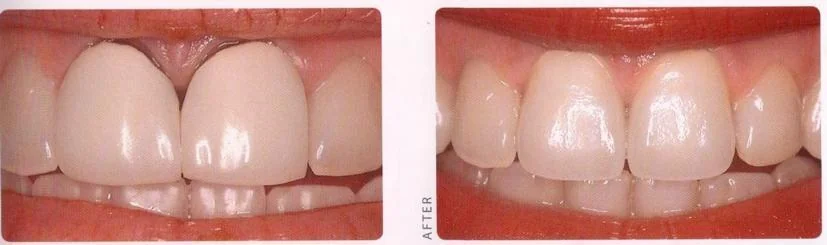 Aesthetic limitations of titanium porcelain crowns