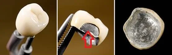Porcelain chipping on titanium implant crown