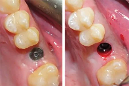 Stock healing abutment in the mouth