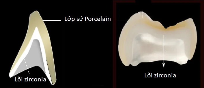 Zirconia-core crown structure