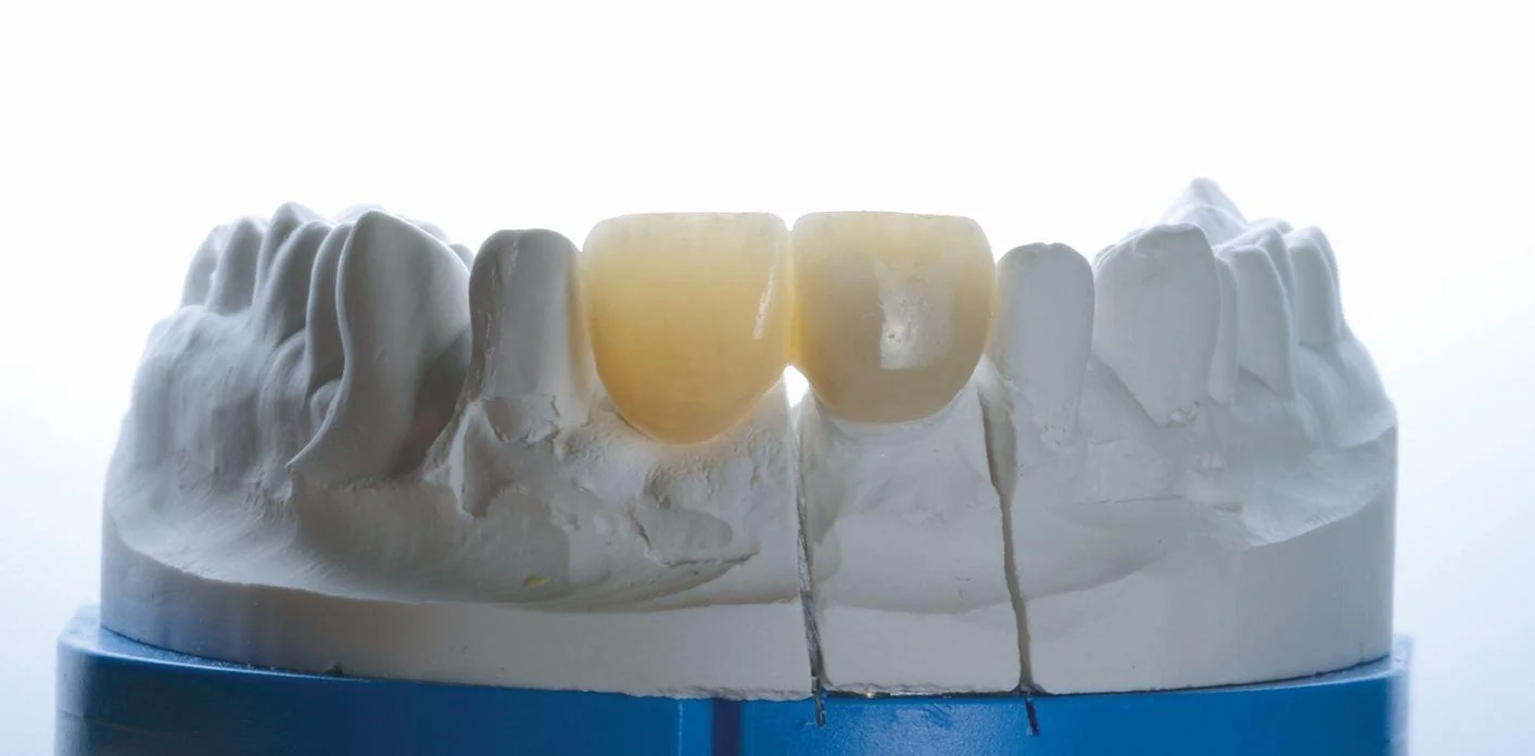 Light refraction of zirconia-core crowns