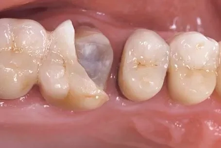 Porcelain delamination in zirconia-core crown