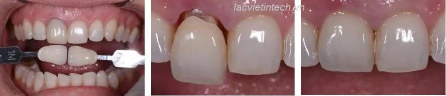 A clinical case of replacing an old ceramic crown with 3D Pro ML