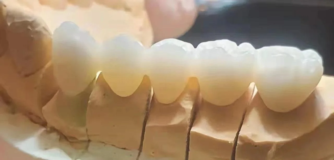 The translucency of the 3D Pro Multilayer ceramic crown in natural light