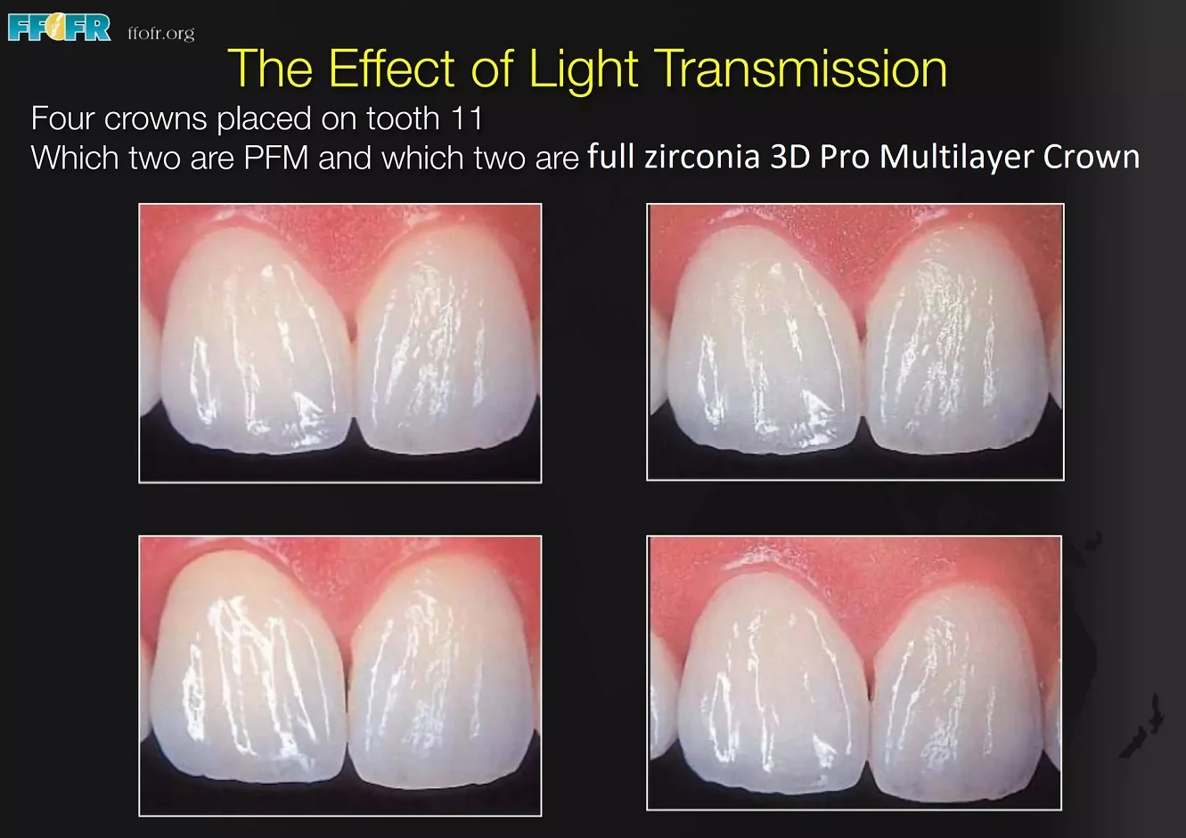 PFM crown replaced by multilayer zirconia