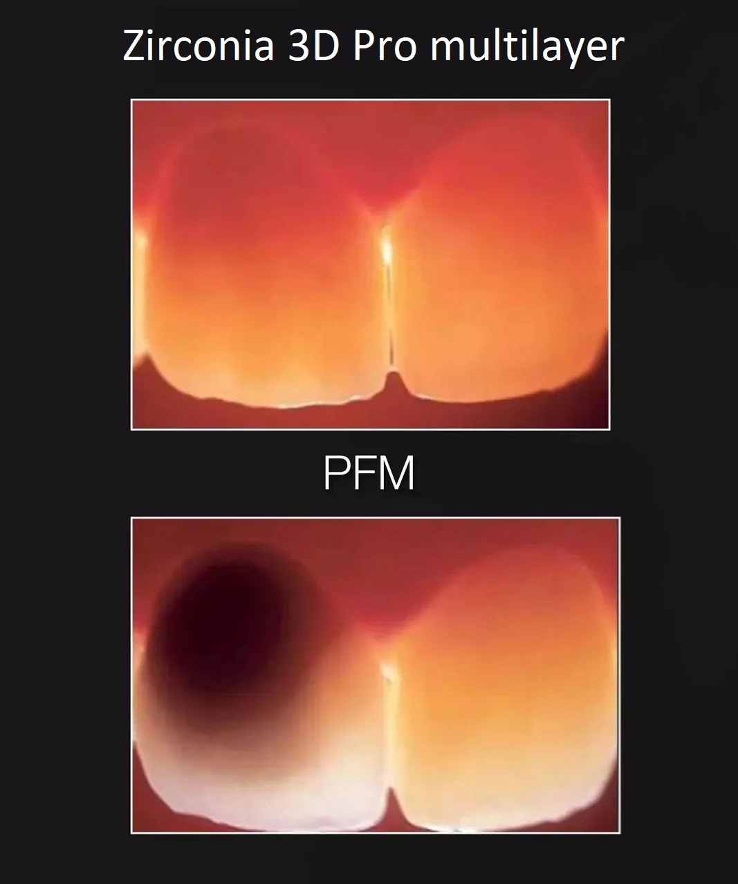 Light transmission comparison among crown materials