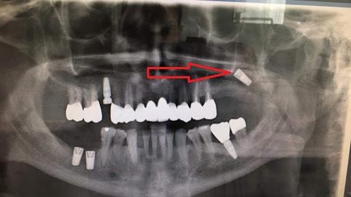 dental implant risks