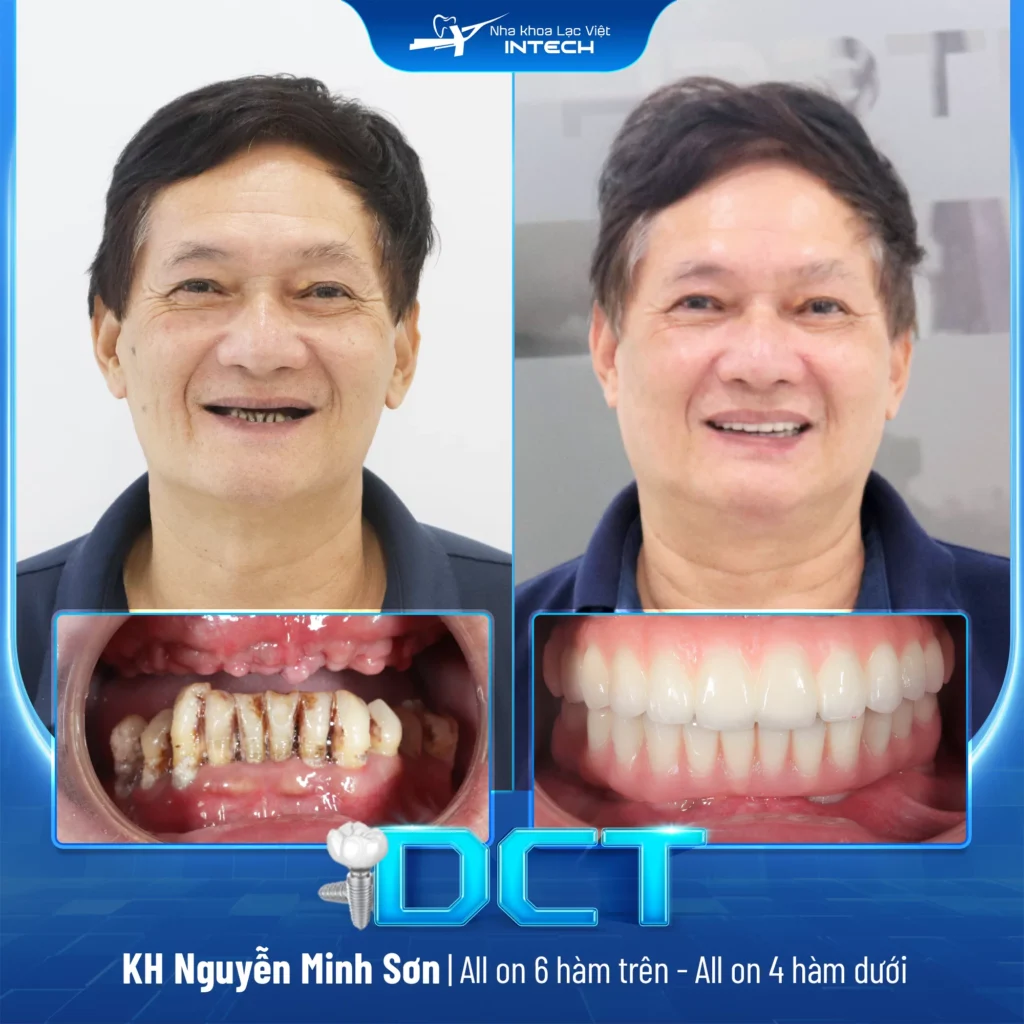 Patient Nguyen Minh Son - Full upper arch All-on-6 and full lower arch All-on-4 implant placement.